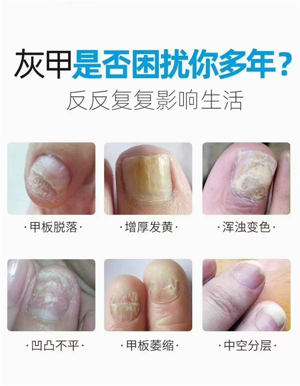 内蒙古灰指甲初期有什么症状？